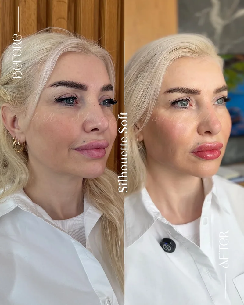 Before and after image for case 14